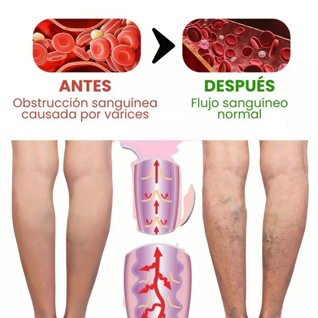 Varicose veins crema para varices